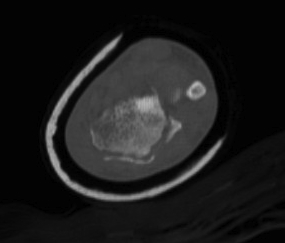 Radiocarpal Dislocation CT 1